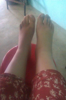 swollen foot in india